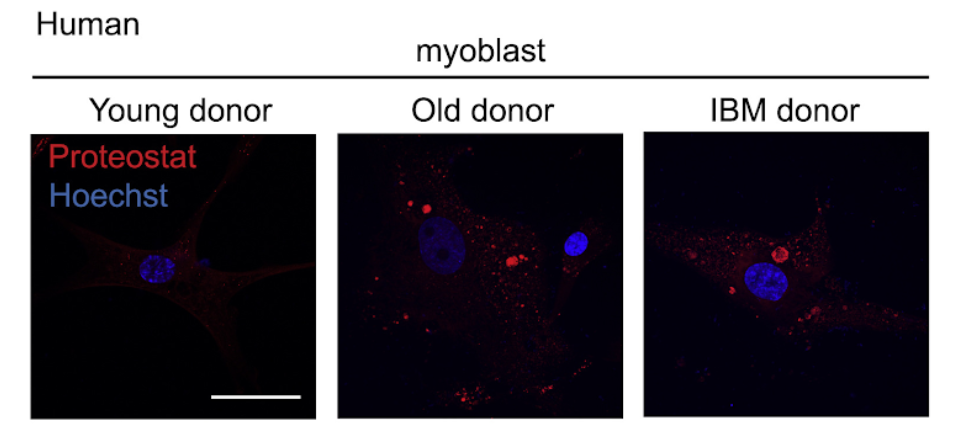 Accumulation of amyloid-like deposits in aging and IBD human muscle cells. Accumulation of amyloid-like deposits in aging and IBD human muscle cells.