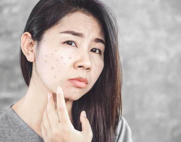 Correlation between glutathione and acne severity Correlation between glutathione and acne severity